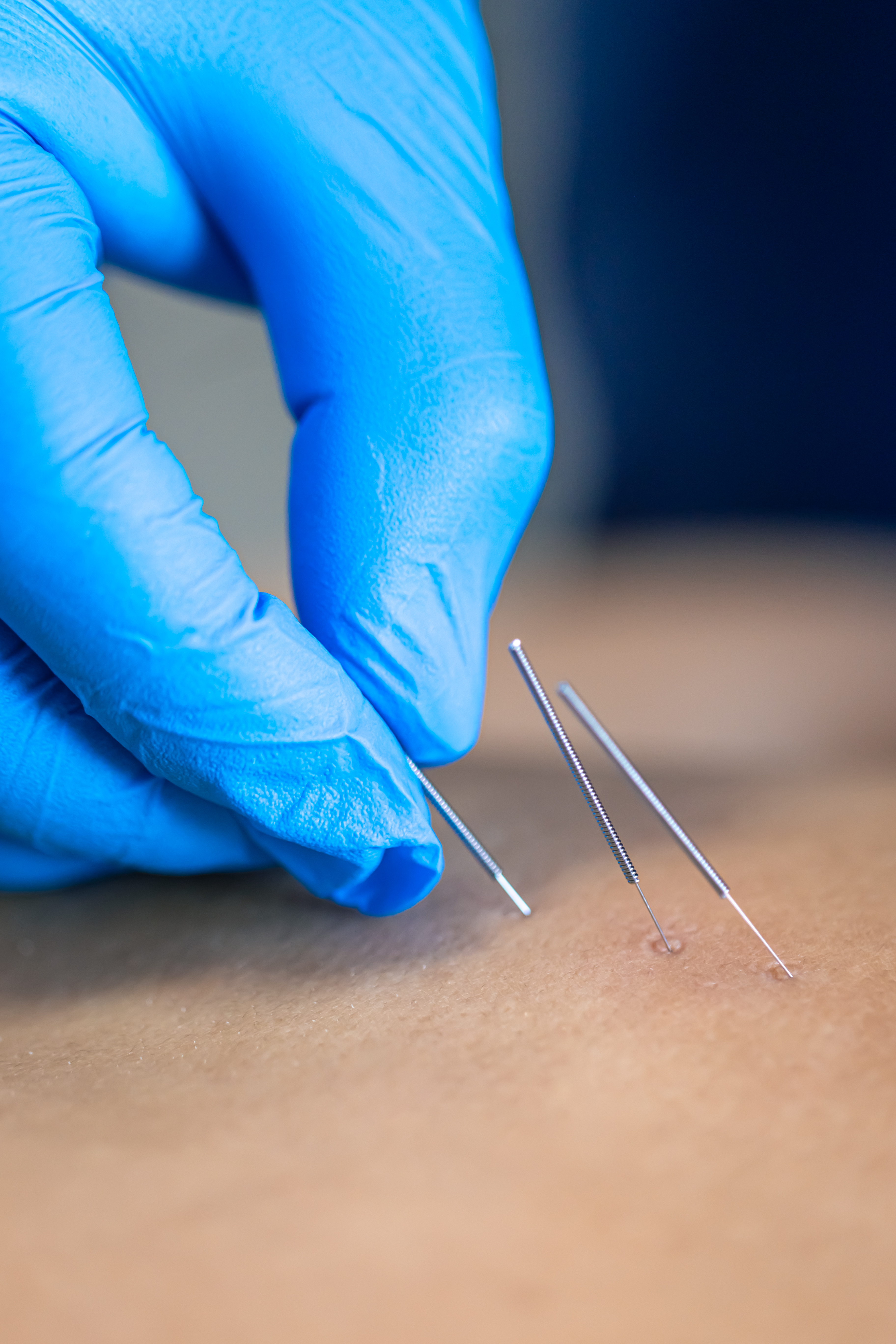 Dry Needling